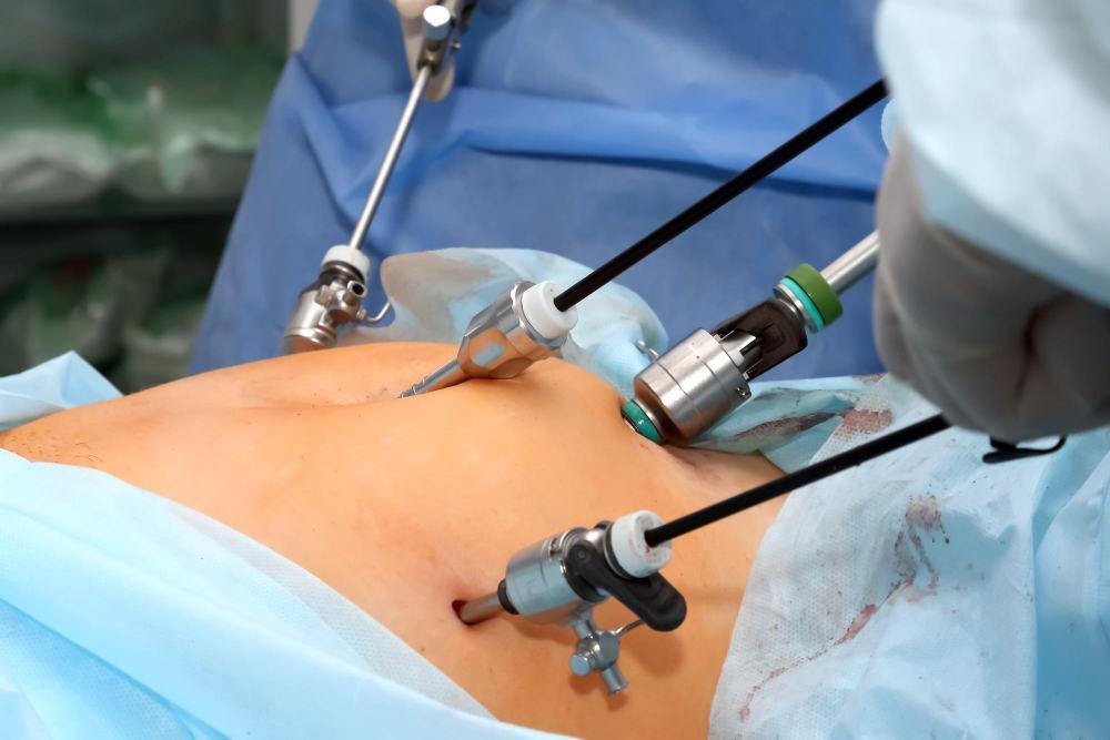 What Is Laparoscopic Appendectomy